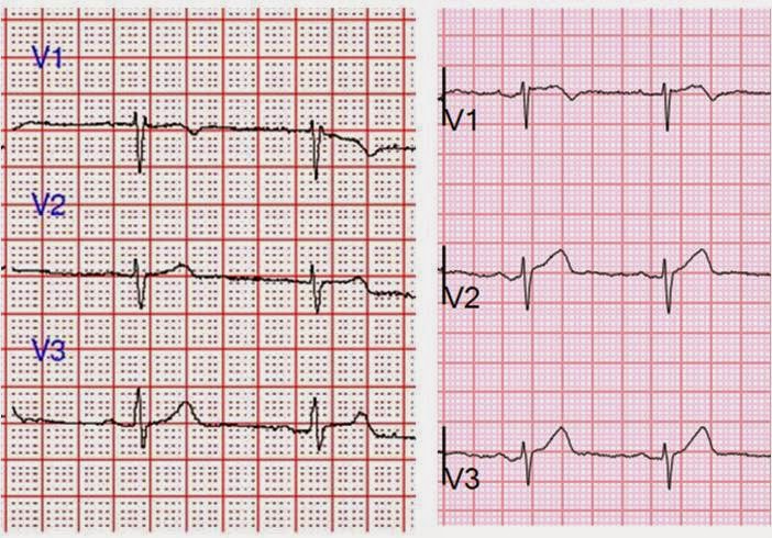 What is the meaning a poor R-wave progression in a cardiogram?